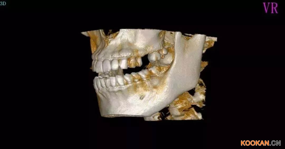 采購口腔CBCT，多大的視野比較好